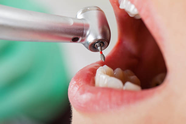 Best Emergency Dental Care for Broken or Chipped Teeth in Green Springs, OH